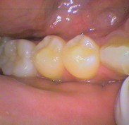 The teeth