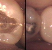 Crack found under filling then filling protecting tooth