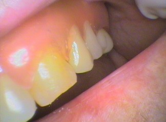 Flexible Denture (Valplast) and Crown placed on back tooth