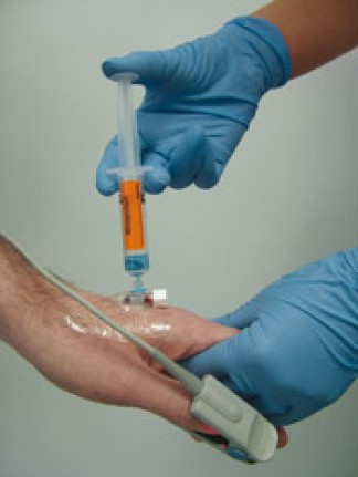 Medication for sedation placed into the vein. Pulsimeter clipped on the thumb to monitor the pulse