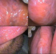 Under the tongue (top views) & side of tongue (lower views) white streaks – Referred to oral surgeon