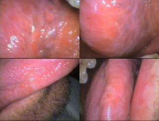 Under the tongue (top views) & side of tongue (lower views) white streaks – Referred to oral surgeon