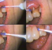 Interdental brush - (Top left) Between teeth on root surface; (Top right) Between roots from front; (Bottom left) Between roots from side; (Bottom right) At contact point