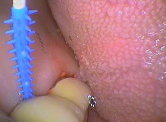 Caredent brush under pontic (false tooth)