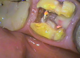 Pus draining through a root canal