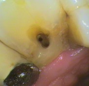 Exposed root canal with no tissue or symptoms