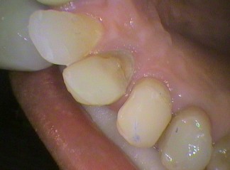 533 for the the two back teeth at the bottom of the photo; and 523 for the front teeth at the top