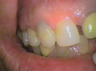 Front tooth adhesive filling with two corners build up: 525, 578 x 2
