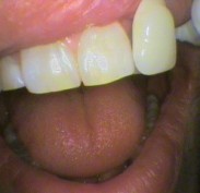 Teeth colour shade A2 after bleaching