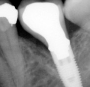 Implant crown using item no. 672 and 661