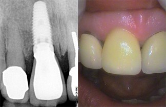 Left: X-ray of upper right Incisor Implant with crown attached; Right: Photo of upper right incisor implant with crown attached.