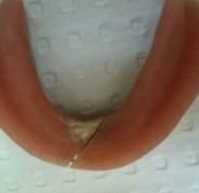 Broken lower full denture