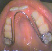 Fixed palatal arch appliance - Item 841