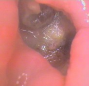 Exposed bone at the base of a dry socket