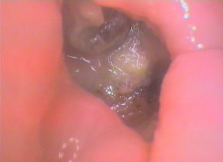 Exposed bone at the base of a dry socket