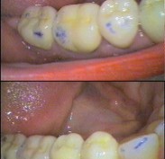 Above: large bruxofacets and heavy supracontacts; Below: after adjustment - light even contacts