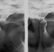 Xray of Jaw joint in closed position (RCP) and Jaw joint in maximum open position (T)