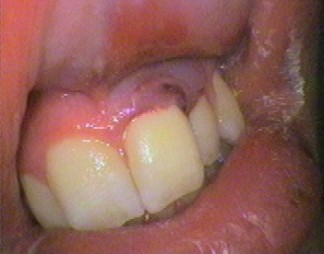 Knocked out tooth placed back - notice bruising in gums and lip