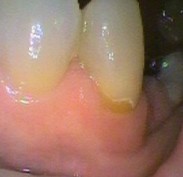 Gum line decay from a denture clasp due to denture left in overnight