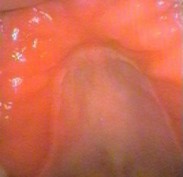 Inflamed palate from a fungal infection under horseshoe shaped denture