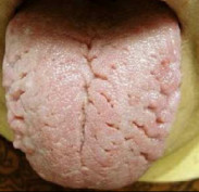 Fissured rough tongue - does your tongue look like this?