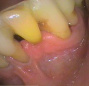 Lower front teeth Splinted with tooth coloured filling