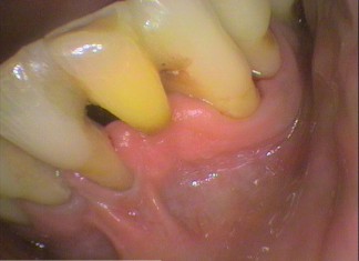 Lower front teeth Splinted with tooth coloured filling