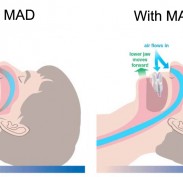 How mandibular advancement device (MAD) works