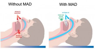 How mandibular advancement device (MAD) works