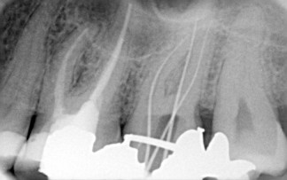 Xray - 1st: Molar - root canal sealed; 2nd: Molar - files in canal to check lengths