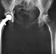 Prosthetic hip joint - Reference Wikipedia