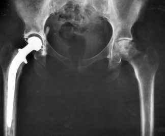 Prosthetic hip joint - Reference Wikipedia