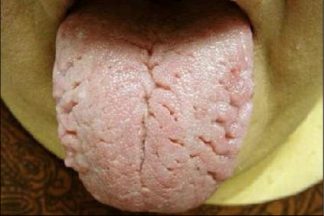 Fissured rough tongue - dry mouth