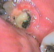 Supparation - pus formation in the gums