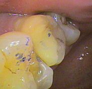 High spot on second molar with a tooth coloured filling found by ink bit of paper - needs to be adjusted