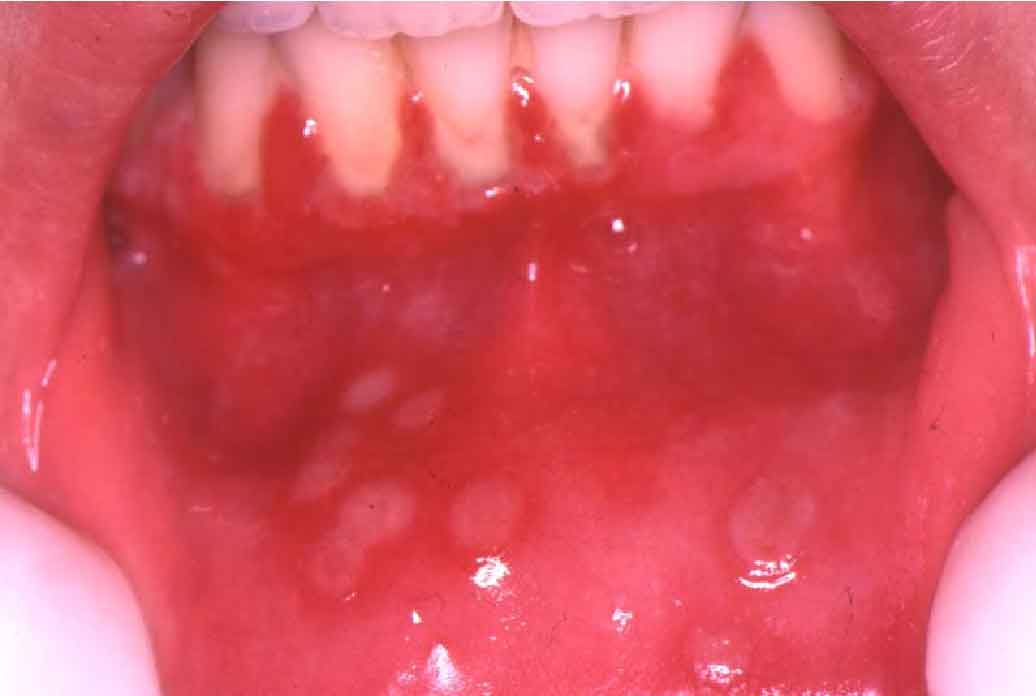 Herpes 2 In The Mouth