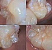 Hypocalcification of all first molars