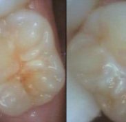 Left: Hypocalcified fissure; Right: fissure sealant treatment