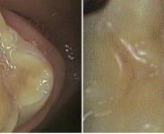 Left - loss of tooth structure and decay with hypocalcification; Right - tooth coloured filling placed