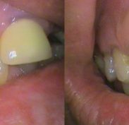 Right: Worn teeth causing overclosure of bite; Left: Front view of build-up & fillings - getting back to a normal bite & look