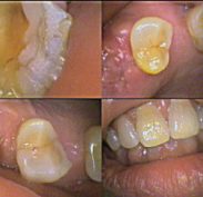 Severely worn teeth loss of teeth drifted teeth and deep bite
