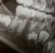 Permanent teeth forming under the baby canine and two baby molars