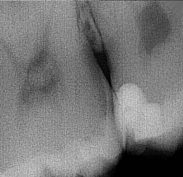 Small dark shadow between the molars opposite the filling