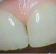 Right half teeth lean inwards with Left half teeth with a straighter look